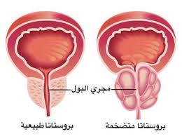 /تجريف ورم بروستات  اقل من ساعة